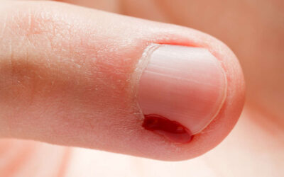 What Causes Hangnails And How to Avoid Them