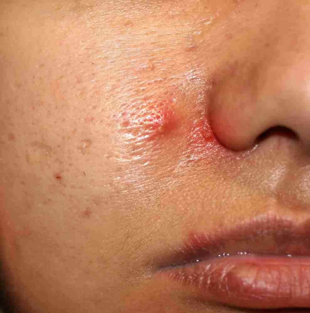 acne woman face pimples