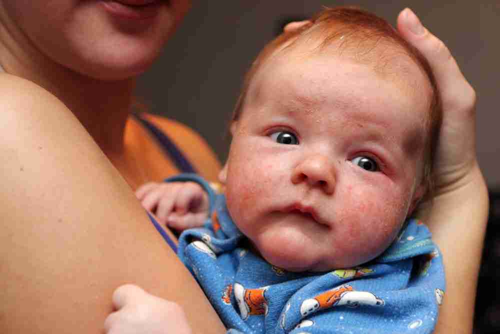 eczema baby face
