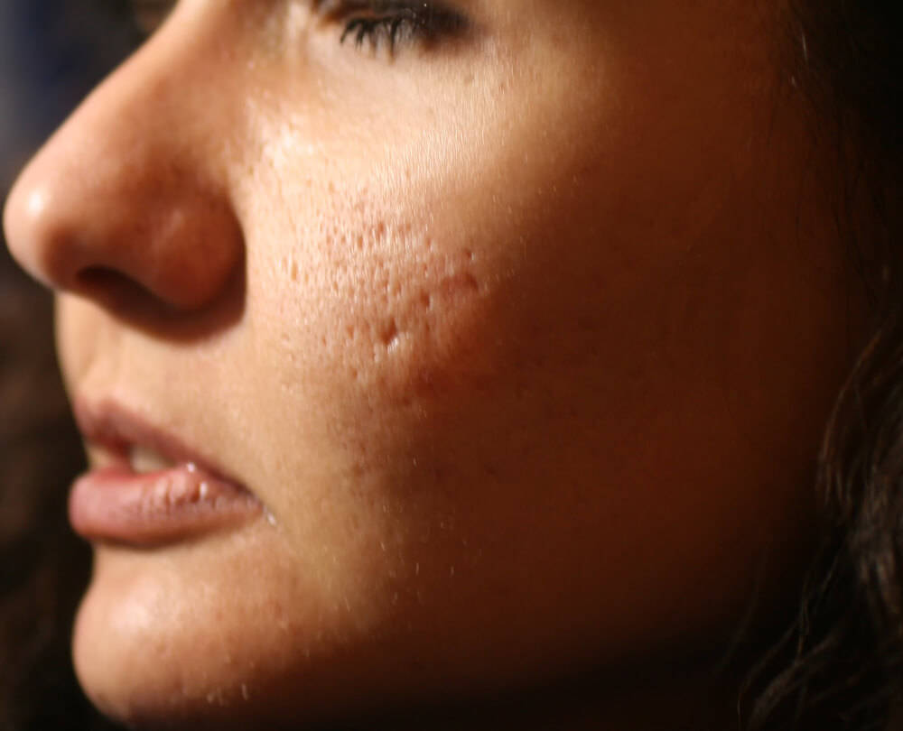 acne scars