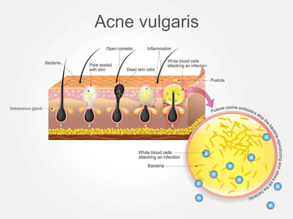 acne vulgaris
