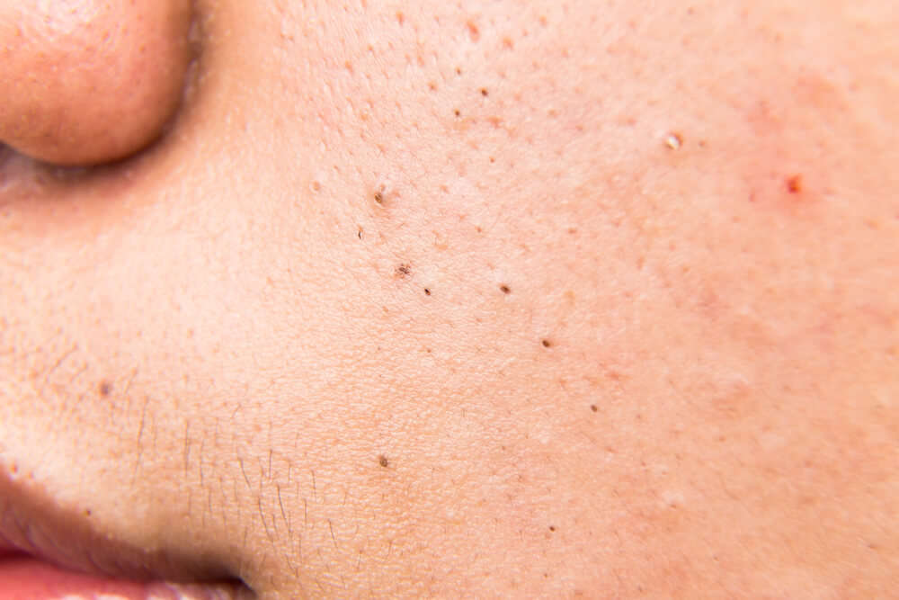 blackheads on cheek