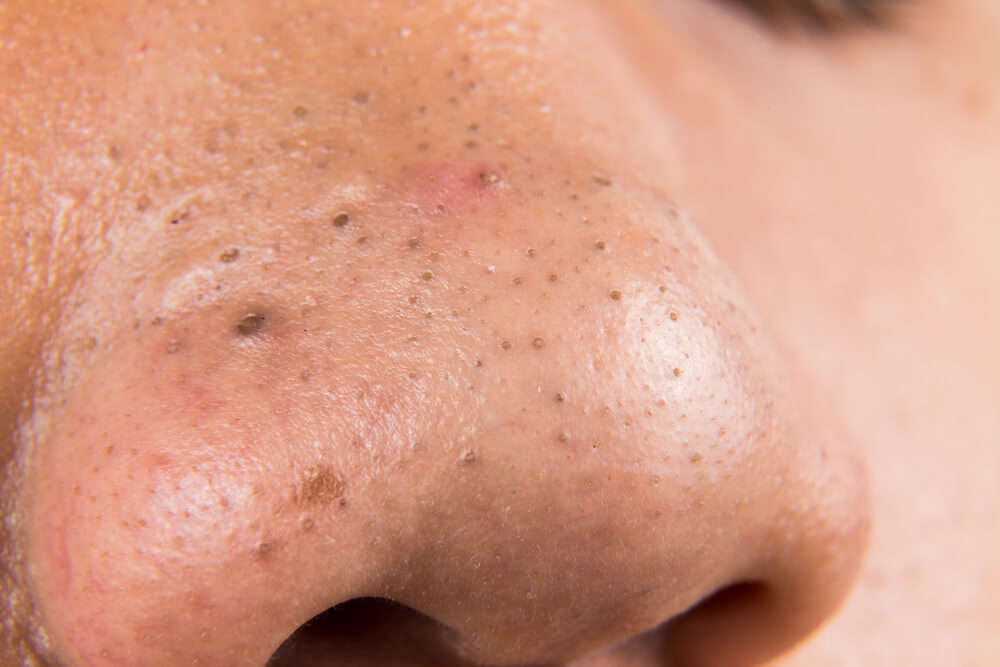 blackheads