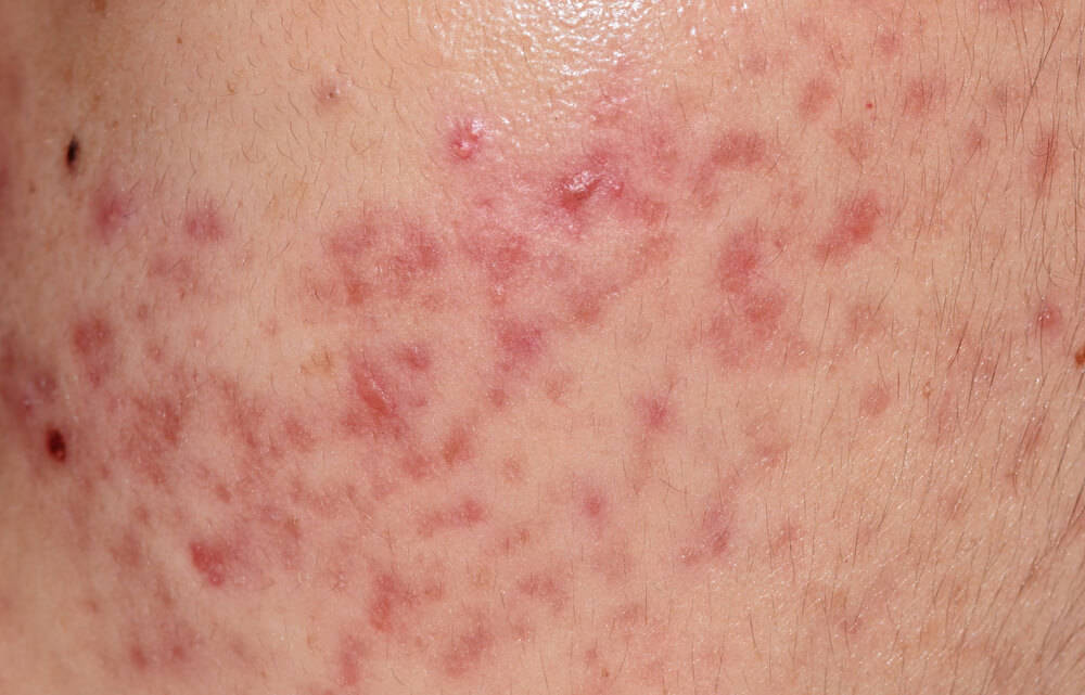 nodular cystic acne skin