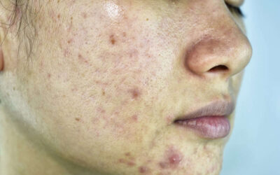 Home Remedies for Pimples and Blackheads for Oily Skin