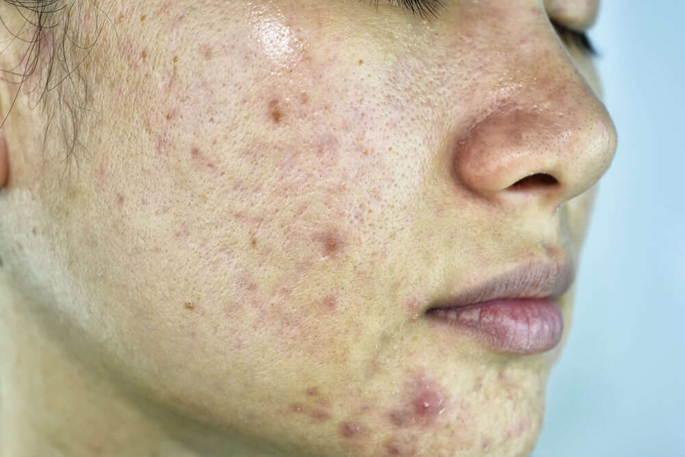 Home Remedies for Pimples and Blackheads for Oily Skin