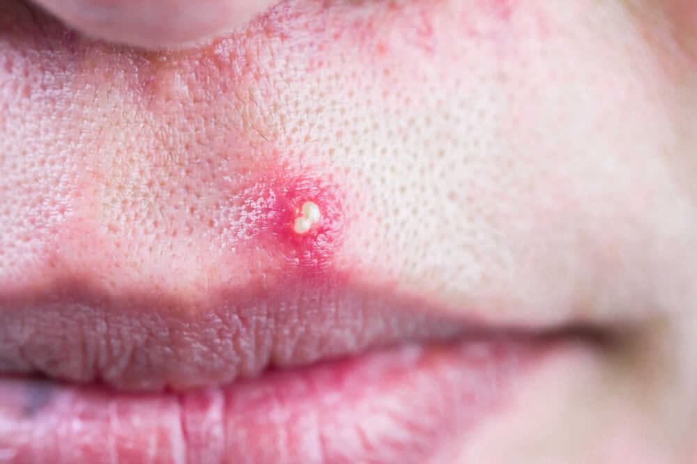 pustules