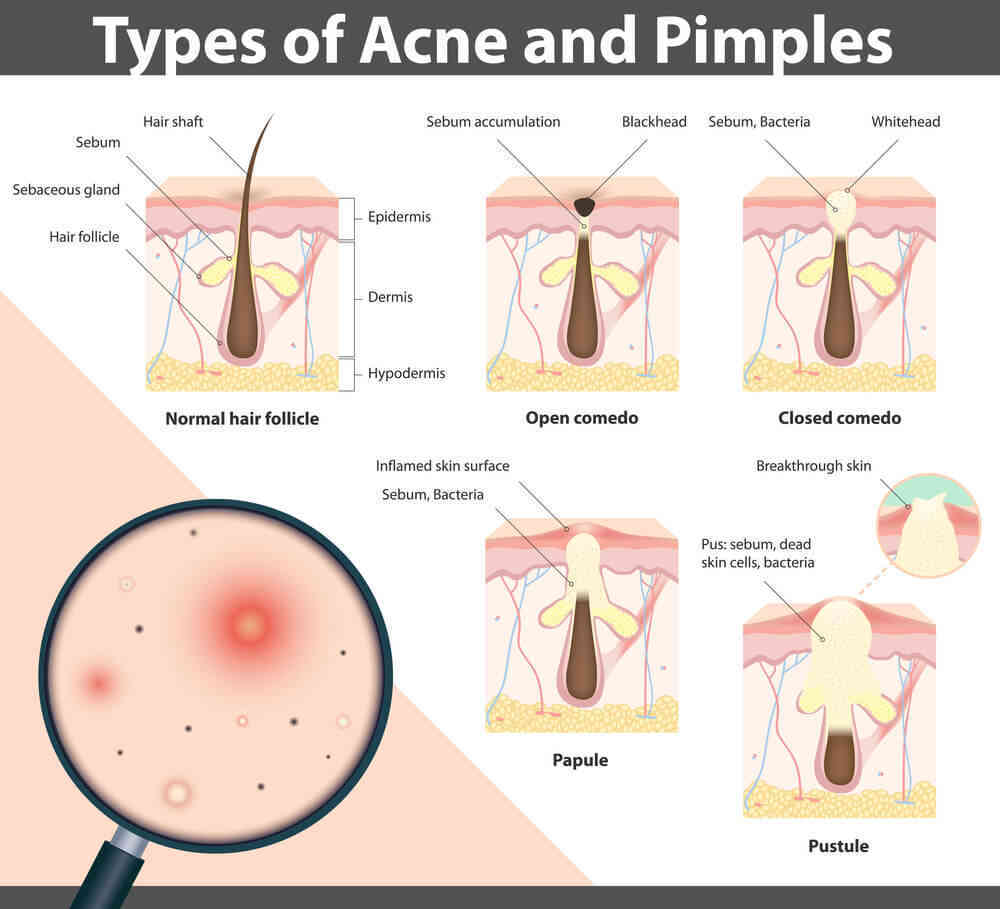 types of acne and pimples
