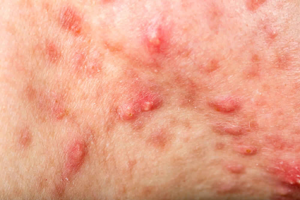 11 Cystic Acne Home Remedies