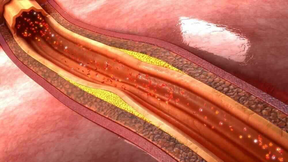how to reduce cholesterol naturally home remedies